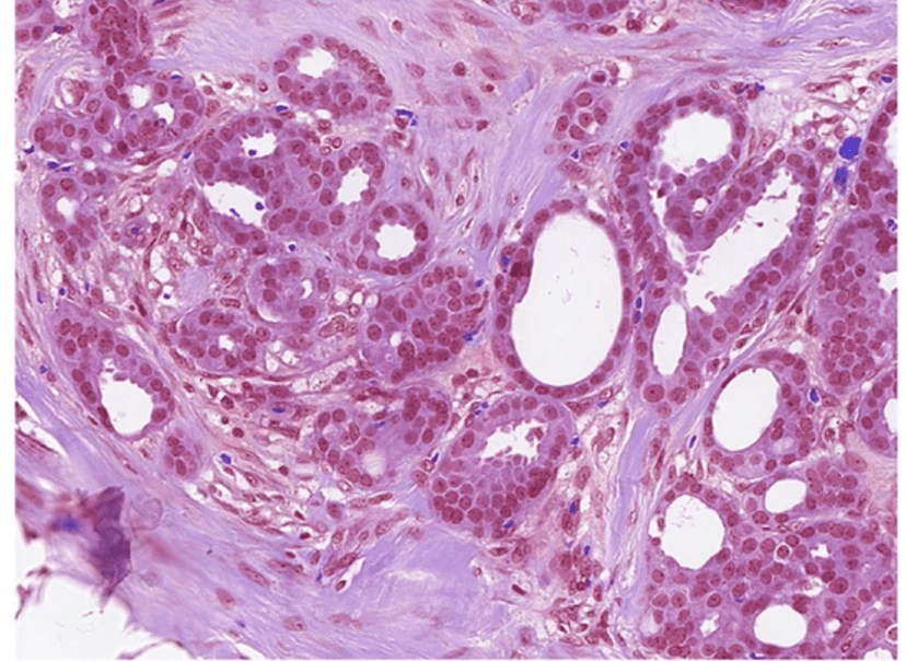 Breast Cancer Detection Model